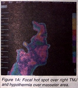 Infra Red Side Facial View