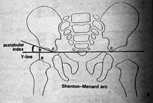 Shenton-Menard arc