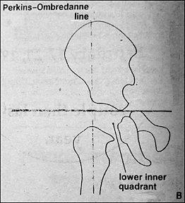 Perkins-Ombredanne Line