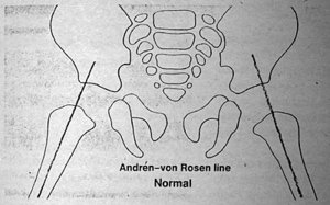 Andren-von Rosen Line
