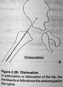 Dislocation