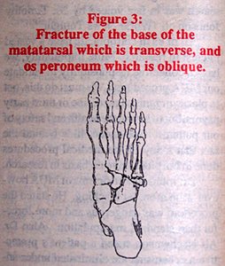 Fracture of the base of the metatarsal which is transverse, and or peroneum which is oblique.