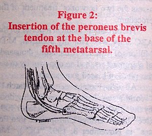 Insertion of the peroneus brevis tendon at the base of the fifth metatarsal.