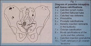 Diagram of possible Intrapelvic soft tissue calcifications