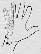 Diagram of Pain Area in Hand