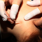 Functional Integrated Needling