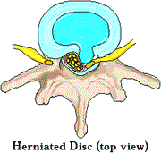 Herniated Discs Image02