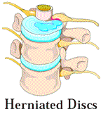 Herniated Discs Image01